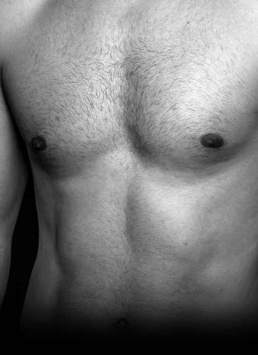 thierrybron gynecomastie thierrybron gynecomastie